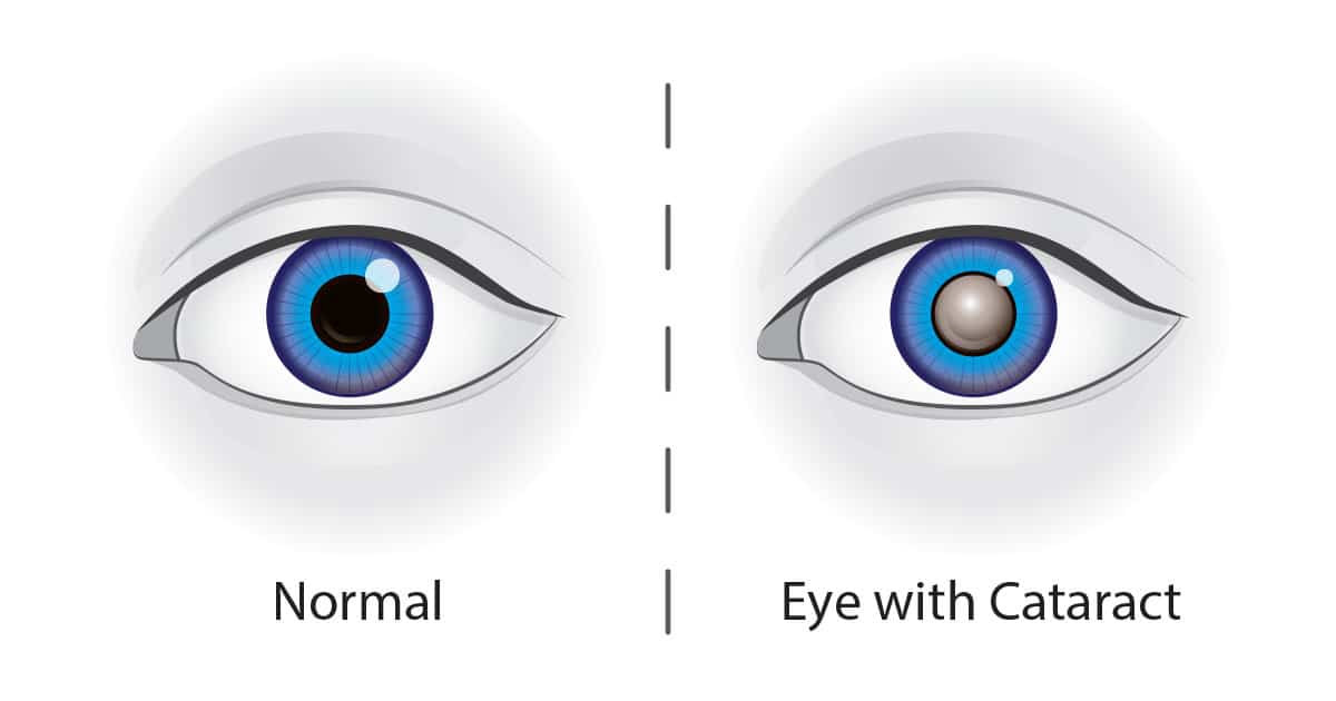 Normal Eye vs. Eye with Cataract