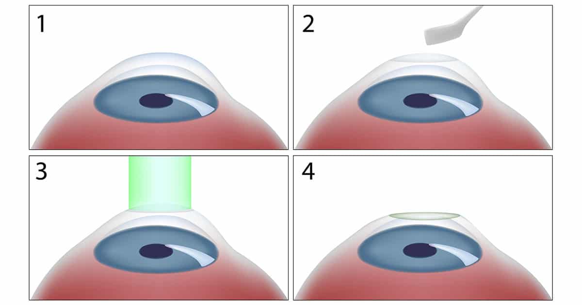 PRK Eye Surgery Steps